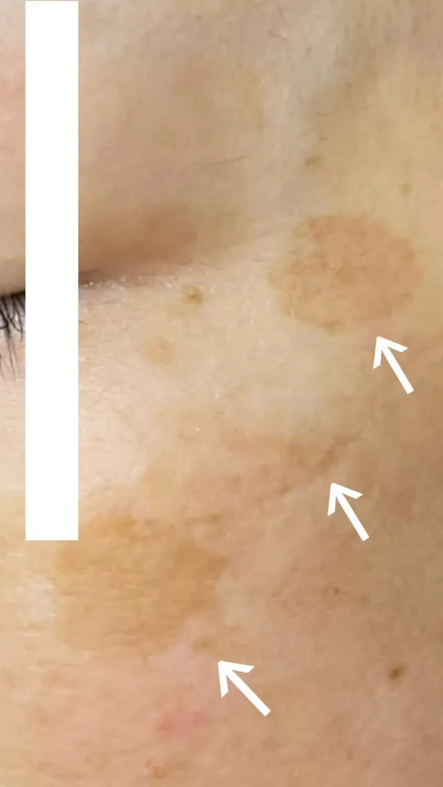 シミを改善したい！